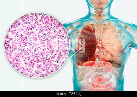 Lobar pneumonia, Illustration und leichte Schliffbild Stockfoto