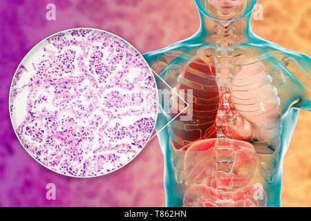 Lobar pneumonia, Illustration und leichte Schliffbild Stockfoto