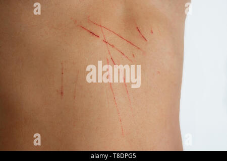 Wunden auf der Haut Katze Kratzern. Haut mit Wunden. irritierte Haut. Pflege der Haut Wunden im Sommer. Weißer Hintergrund Stockfoto