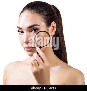 Schöne Frau mit Vitiligo hält Lupe. Stockfoto