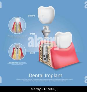 Menschlichen Zähnen und zahnmedizinische Vektor-illustration Implantat Stock Vektor