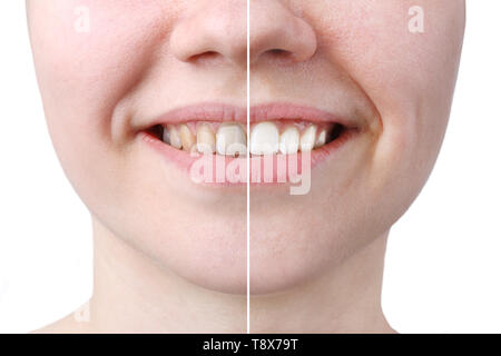 Weiß werden oder die Behandlung bleichen, vor und nach, Frau Zähne und Lächeln, Nahaufnahme, auf weißem Hintergrund. Stockfoto