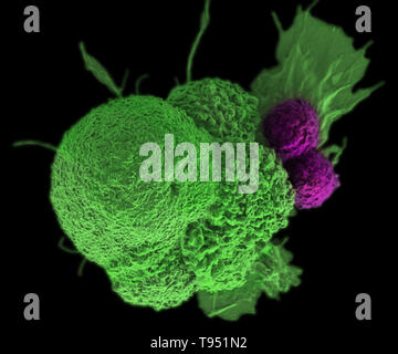 Diese Electron Micrograph (SEM) zeigt eine oral squamous cancer Cell (grün), die angegriffen wurde durch zwei zytotoxische T-Zellen (lila). Der tumor-spezifischer T-Zellen vom eigenen Immunsystem des Patienten entwickelt wurden, eine personifizierte Impfstoff gegen Krebs wie jene, die in der Zukunft mit Hilfe standardisierter Menschenrechte der NIST Genome entwickelt werden können. Dieses Bild hat eingefärbt worden. Stockfoto