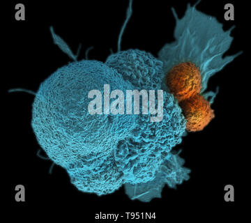 Diese Electron Micrograph (SEM) zeigt eine oral squamous cancer Cell (blau), die angegriffen wurde durch zwei zytotoxische T-Zellen (orange). Der tumor-spezifischer T-Zellen vom eigenen Immunsystem des Patienten entwickelt wurden, eine personifizierte Impfstoff gegen Krebs wie jene, die in der Zukunft mit Hilfe standardisierter Menschenrechte der NIST Genome entwickelt werden können. Dieses Bild hat eingefärbt worden. Stockfoto