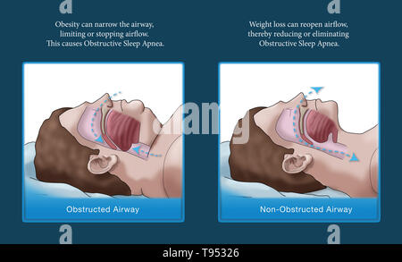 Eine Abbildung der Vergleich eines übergewichtigen und normalen Schlaf. Bei Erwachsenen, Schlafapnoe wird in der Regel von Übergewicht und Fettleibigkeit verursacht. Während des Schlafes, wenn die Kehle, Zunge Muskeln sind entspannt, weiches Gewebe, überschüssiges Fett Einlagen und das Gewicht der Abdominal- Fett Drücken auf die Lunge kann mit normalen Schlaf stören. Stockfoto