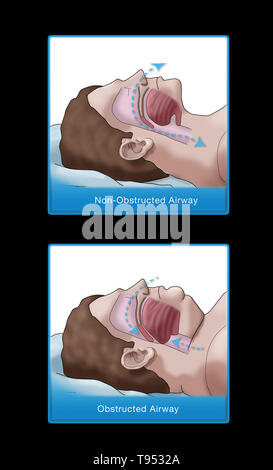 Eine Abbildung der Vergleich eines übergewichtigen und normalen Schlaf. Bei Erwachsenen, Schlafapnoe wird in der Regel von Übergewicht und Fettleibigkeit verursacht. Während des Schlafes, wenn die Kehle, Zunge Muskeln sind entspannt, weiches Gewebe, überschüssiges Fett Einlagen und das Gewicht der Abdominal- Fett Drücken auf die Lunge kann mit normalen Schlaf stören. Stockfoto