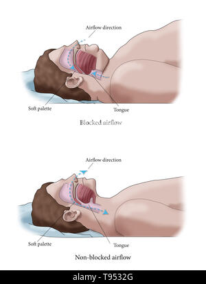 Eine Abbildung der Vergleich eines übergewichtigen und normalen Schlaf. Bei Erwachsenen, Schlafapnoe wird in der Regel von Übergewicht und Fettleibigkeit verursacht. Während des Schlafes, wenn die Kehle, Zunge Muskeln sind entspannt, weiches Gewebe, überschüssiges Fett Einlagen und das Gewicht der Abdominal- Fett Drücken auf die Lunge kann mit normalen Schlaf stören. Stockfoto