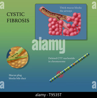 Cystische Fibrose (CF) ist eine genetische Störung, die vor allem die Lunge, sondern auch die Bauchspeicheldrüse, Leber, Nieren und Darm. Langfristige Probleme gehören Atembeschwerden und Husten Schleim infolge der häufigen Lungenentzündungen. Andere Anzeichen und Symptome können gehören Nebenhöhlenentzündungen, schlechtes Wachstum, fettiger Stuhl, Clubbing der Finger und Zehen, und Unfruchtbarkeit in einige Männer. Andere Leute können unterschiedliche Grade der Symptome haben. Stockfoto