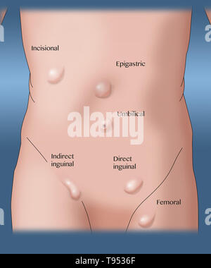 Eine Abbildung zeigt die verschiedenen Arten von Hernien. Stockfoto