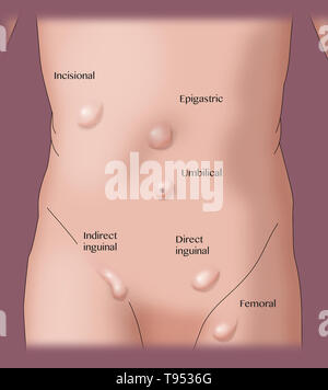 Eine Abbildung zeigt die verschiedenen Arten von Hernien. Stockfoto
