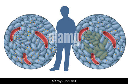 Eine Abbildung zeigt normale Insulin (links) und Beschädigung der Insulin-produzierenden Zellen (rechts) in der Kindheit, Typ 1 Diabetes. Stockfoto