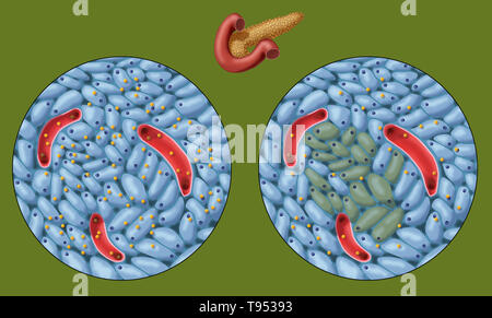 Eine Abbildung zeigt normale (links) und Beschädigung der Insulin-produzierenden Zellen (rechts) bei Typ 1 Diabetes. Stockfoto