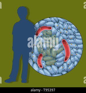 Eine Abbildung mit beschädigten Insulin-produzierenden Zellen in der Kindheit Diabetes Typ 1. Stockfoto