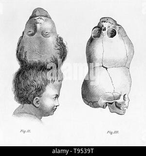 Die so genannte "Der Zweiköpfige Boy von Bengalen" wurde im Jahre 1783 geboren und starb an einem Cobra Happen in 1787. Sein Schädel bleibt in der Sammlung des Hunterian Museum der königlichen Hochschule der Chirurgen von London. Craniopagus parasiticus ist eine extrem seltene Art der parasitären Twinning in etwa 4 bis 6 von 10.000.000 Geburten. In craniopagus parasiticus, einer parasitären Twin Head mit einem Unentwickelten Karosserie ist den Kopf eines entwickelten Twin befestigt. Stockfoto