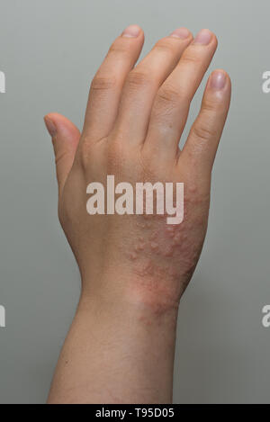 Gürtelrose (Herpes zoster) Hautausschlag an Hand Stockfoto