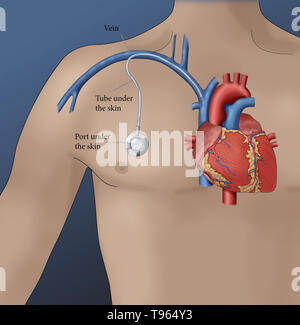 Abbildung: einen venösen Zugang Port, ein kleines medizinisches Gerät, mit Drogen injiziert werden und Blutproben mit weniger Beschwerden gezogen werden als eine Nadel verursachen würde. Stockfoto