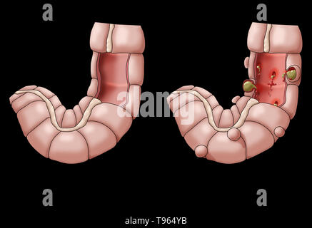 Abbildung: Vergleich der Darstellung eines gesunden Doppelpunkt (links) und Divertikulitis (rechts). Stockfoto