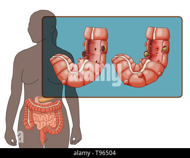 Abbildung: Vergleich der Darstellung von divertikulose und Divertikulitis (links) (rechts); eine weibliche Silhouette mit dem Verdauungssystem markiert ist im Hintergrund. Stockfoto