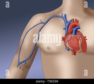 Abbildung: Darstellung einer PICC (peripher zentralen Katheter eingeführt), eine Form der intravenösen Zugang, die für einen längeren Zeitraum verwendet werden können (wie bei Chemotherapien, zum Beispiel). Stockfoto