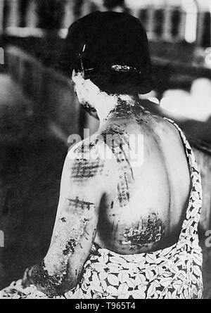 Am 6. August 1945, in der Nähe des Ende des Zweiten Weltkriegs, in den Vereinigten Staaten fiel eine Atombombe auf die japanische Stadt Hiroshima, zerstören die Stadt und töten über 70.000 Menschen. In diesem Bild von einem medizinischen Bericht der Bombardierung, die dunkel-farbige Muster der Kleidung der Frau gezeigt wird thermische Energie absorbiert und verbrannte die Haut, besonders um mehr eng anliegende Gebiete, wie die Schultern. Stockfoto