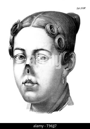 Chirurgische Erfahrungen. Frau mit keine Nase. Johann Friedrich Dieffenbach (Februar 1, 1792 - November 11, 1847) war ein deutscher Chirurg, spezialisiert auf Haut Transplantation und plastische Chirurgie. Seine Arbeit in der rhinoplastic Mund-, Kiefer- und Gesichtschirurgie etabliert Viele moderne Techniken der rekonstruktiven Chirurgie. Vor der Entdeckung von Blut und Blut matching, Dieffenbach recherchiert Bluttransfusion. Stockfoto