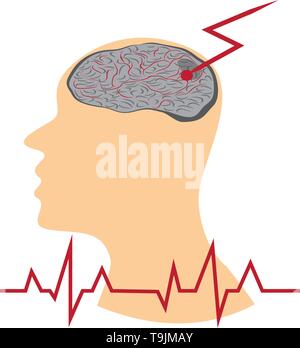 Schlaganfall entwickeln in menschlichen Gehirnen vecroe Abbildung Stock Vektor