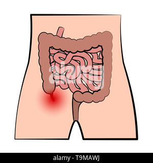 Entzündete Anhang. Schematische Darstellung der blinddarmentzündung und das Verdauungssystem auf weißem Hintergrund. Stockfoto