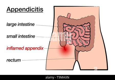 Blinddarmentzündung. Entzündete Anhang. Mit der Bezeichnung Chart mit großen und kleinen Darm, Anlage und Rektum auf weißem Hintergrund. Stockfoto