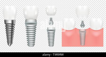 Menschlichen Zähnen und zahnmedizinische cut Regelung Implantat, Vector Illustration. Zahnmedizinische Struktur Implantat mit allen Teilen Krone, Widerlager, Schraube. medizinisches Bildmaterial. Stock Vektor