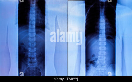 X-ray der Wirbelsäule einer Frau Stockfoto