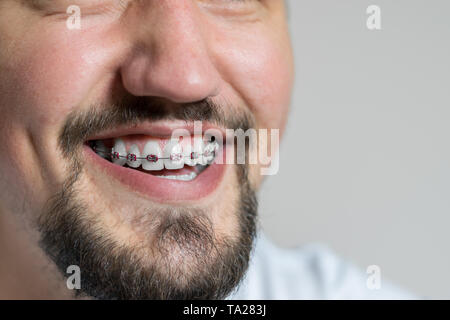 Nahaufnahme von einem jungen Mann mit Klammern lächelnd. Makroaufnahme eines jungen Mannes mit Klammern auf einem weißen Hintergrund. Stockfoto