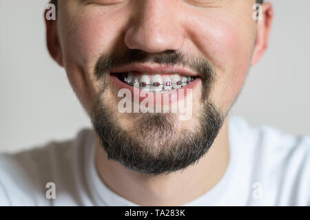 Nahaufnahme von einem jungen Mann mit Klammern lächelnd. Makroaufnahme eines jungen Mannes mit Klammern auf einem weißen Hintergrund. Stockfoto