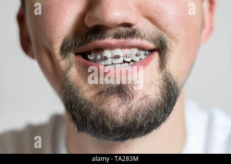 Nahaufnahme von einem jungen Mann mit Klammern lächelnd. Makroaufnahme eines jungen Mannes mit Klammern auf einem weißen Hintergrund. Stockfoto