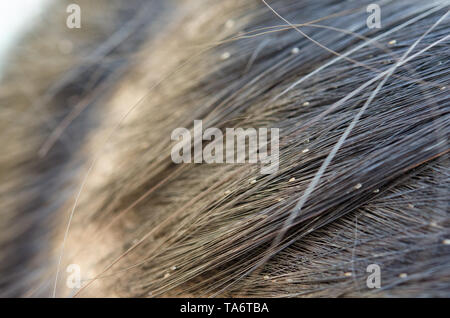 Laus Ei auf dem Haar verursacht Juckreiz Kopf. Stockfoto