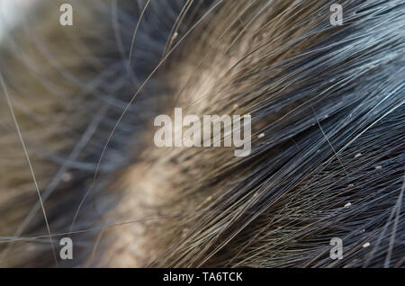 Laus Ei auf dem Haar verursacht Juckreiz Kopf. Stockfoto