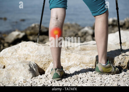 Frau mit Krampfadern auf einem Bein Walking mit Trekking Stöcke. Red dot Effekt. Stockfoto