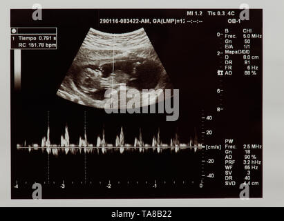 Ultraschall der Zukunft Baby mit Herzschlag Parameter Stockfoto