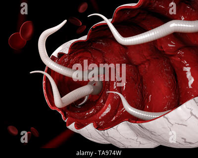 3D-Darstellung eines hookworm im Dickdarm. Stockfoto