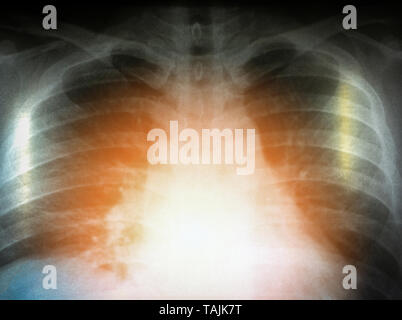 Chest x-ray Film zeigen menschliche medizinische Diagnose Stockfoto