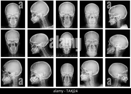 Sammlung Schädel x-ray Bild in Graustufen Stockfoto