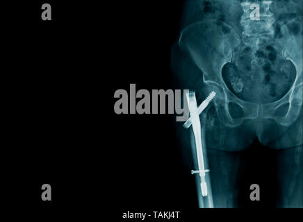 X-ray image Hüftfrakturen oder intertrochanteric Bruch- und Post-interne Fixation, Y-Stütze perkutane interne Fixatoren Stockfoto