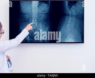 Frau Doktor, der Zeigefinger auf der Wirbelsäule x-ray Bild auf Monitor Stockfoto