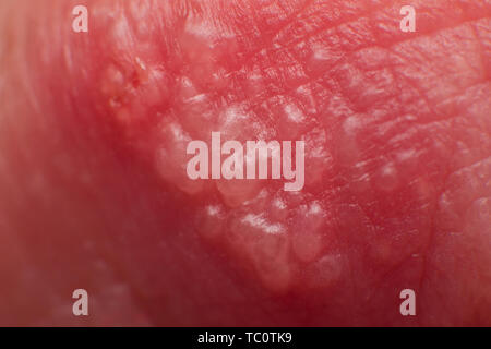 Beginn der wachsenden Herpes auf Kaukasisch männlich Mann auf der oberen Lippe super Makro Mikroskop Stockfoto