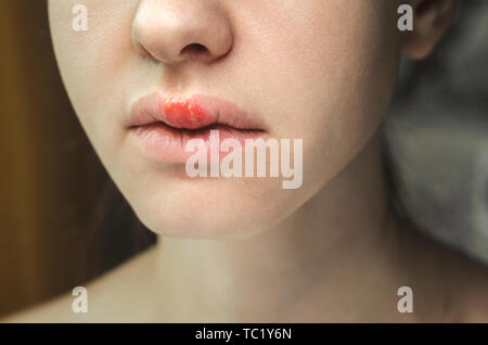 Herpes auf der Oberlippe einer jungen Frau. Medizinischer Hintergrund einer jungen schönen Mädchen mit Herpes labialis. Herpes-simplex-Virus Stockfoto