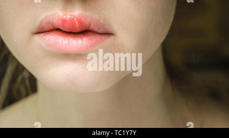 Herpes auf der Oberlippe einer jungen Frau. Medizinischer Hintergrund einer jungen schönen Mädchen mit Herpes labialis. Herpes-simplex-Virus Stockfoto