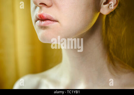 Herpes auf der Oberlippe einer jungen Frau. Medizinischer Hintergrund einer jungen schönen Mädchen mit Herpes labialis. Herpes-simplex-Virus Stockfoto