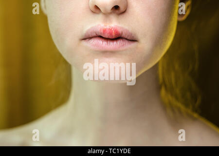 Herpes auf der Oberlippe einer jungen Frau. Medizinischer Hintergrund einer jungen schönen Mädchen mit Herpes labialis. Herpes-simplex-Virus Stockfoto