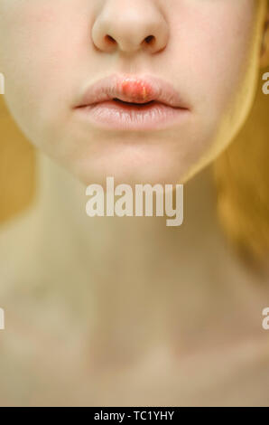 Herpes auf der Oberlippe einer jungen Frau. Medizinischer Hintergrund einer jungen schönen Mädchen mit Herpes labialis. Herpes-simplex-Virus Stockfoto