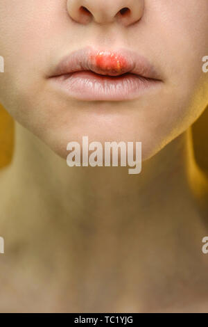 Herpes auf der Oberlippe einer jungen Frau. Medizinischer Hintergrund einer jungen schönen Mädchen mit Herpes labialis. Herpes-simplex-Virus Stockfoto