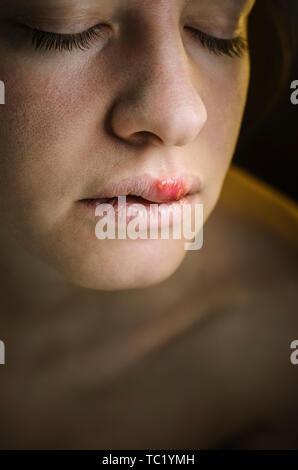 Herpes auf der Oberlippe einer jungen Frau. Medizinischer Hintergrund einer jungen schönen Mädchen mit Herpes labialis. Herpes-simplex-Virus Stockfoto